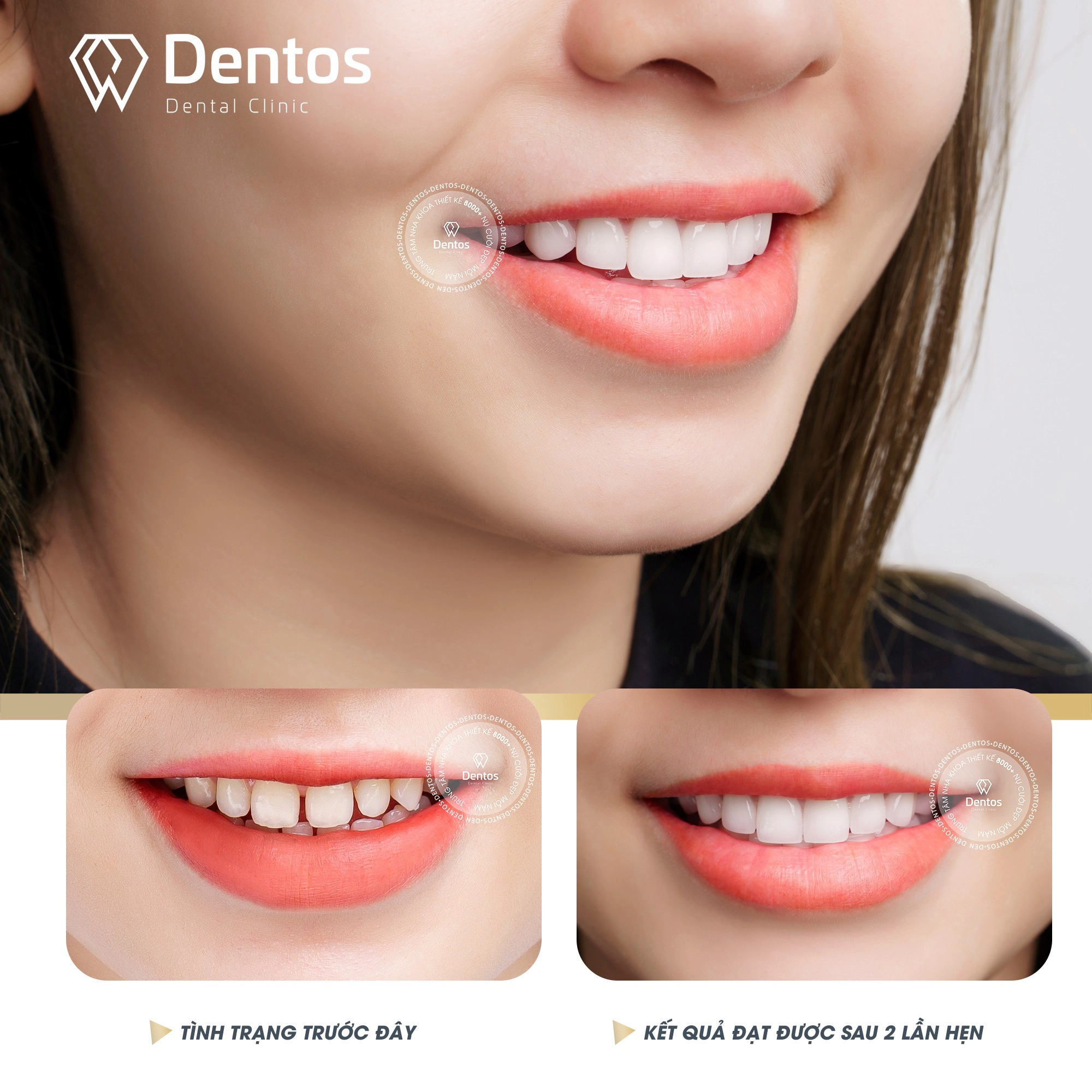 Hơn 30.000 nụ cười được kiến tạo tại Dentos